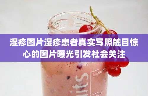 湿疹图片湿疹患者真实写照触目惊心的图片曝光引发社会关注